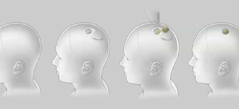 Илон Маск ищет добровольцев для тестирования мозговых чипов Neuralink N1